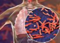 Funding Crisis Jeopardizes TB Efforts